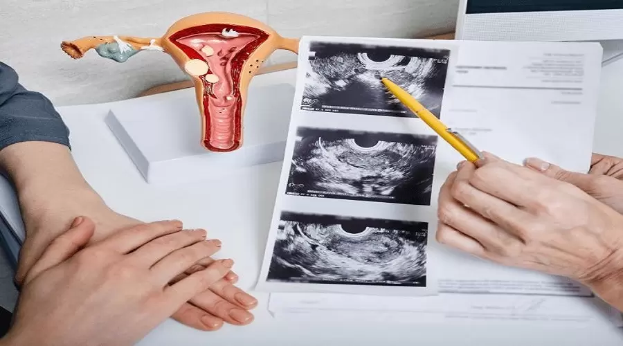 Endometriosis Treatment and Fertility: What You Need to Know